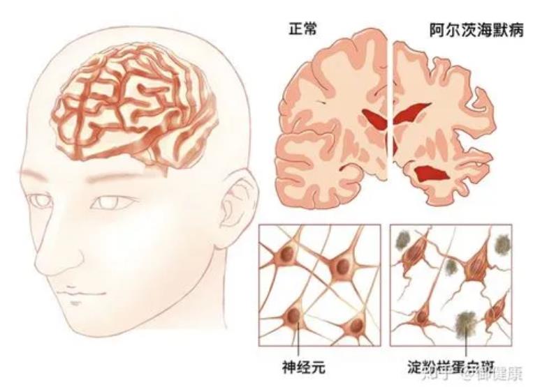 阿尔茨海默症是否属于精神病？